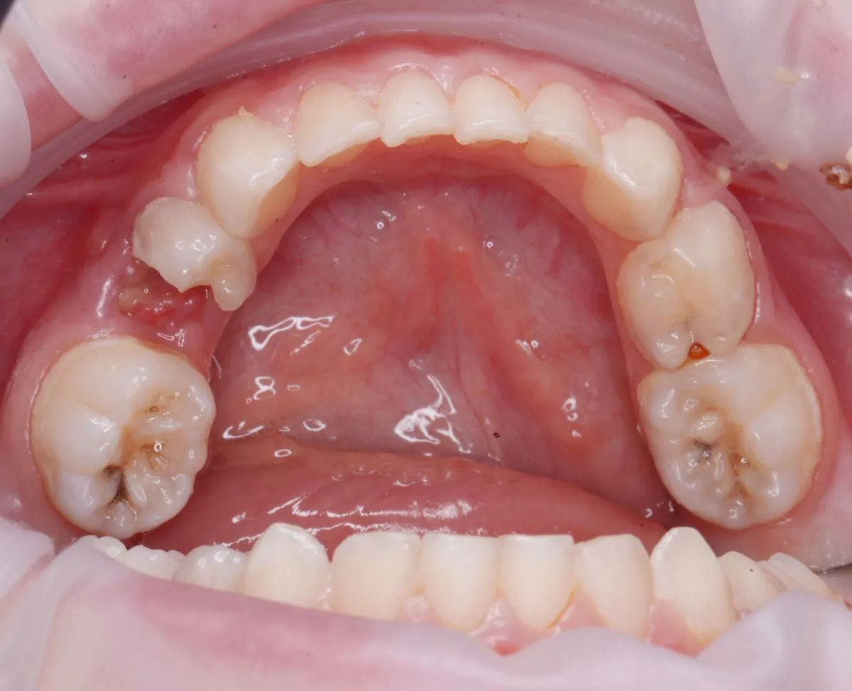 етская стоматология под наркозом Москва. Лечение кариеса и пульпитов под наркозом у детей - до процедуры