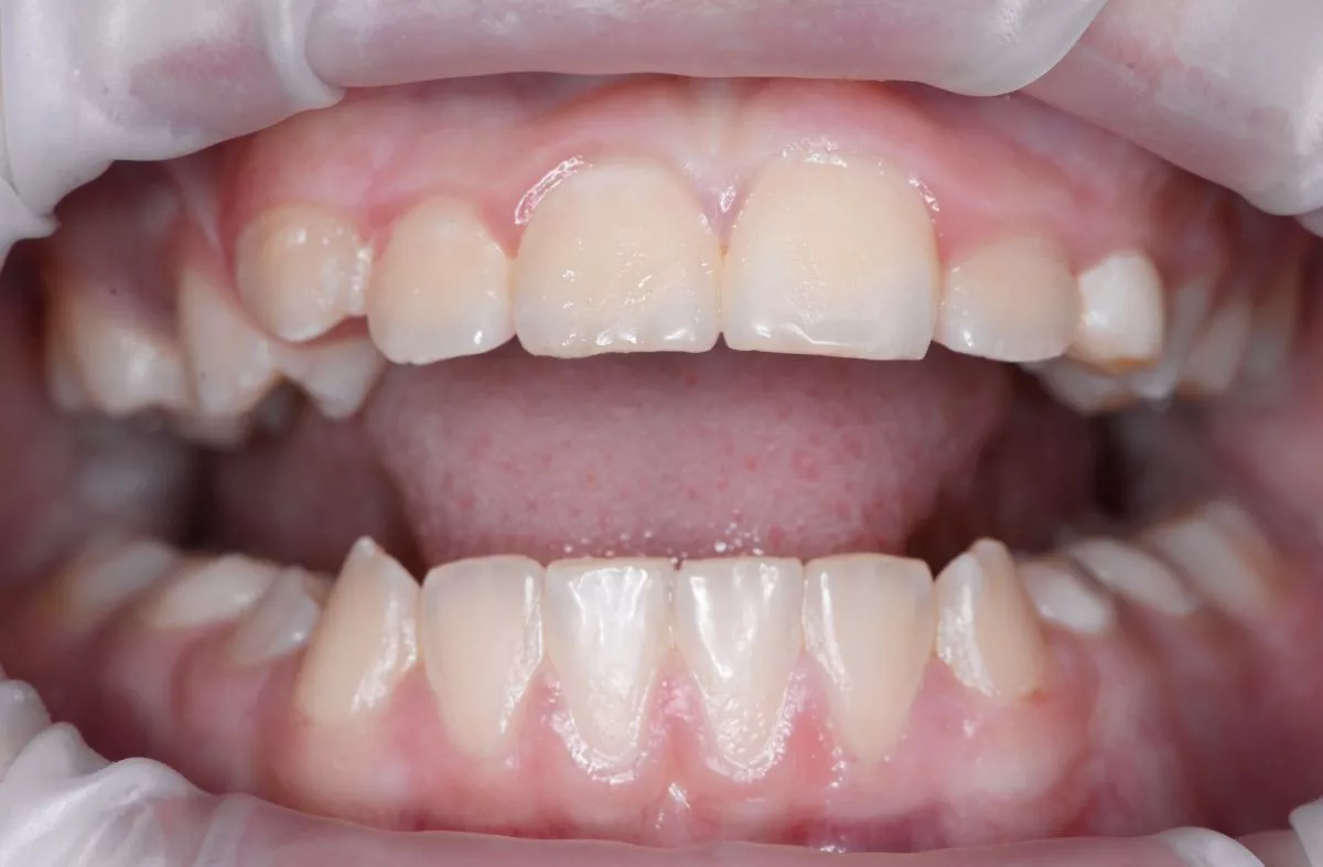 Детская стоматология наркоз Москва. Гигиена сменного прикуса - до процедуры