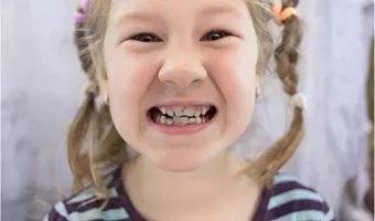 Акулья улыбка у детей - почему зубы растут в два ряда