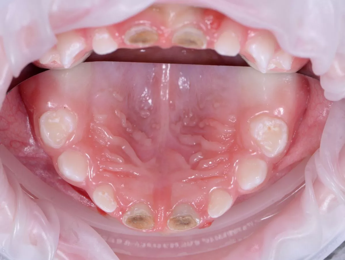 етская стоматология под наркозом Москва. Лечение зубов под наркозам у детей - до процедуры