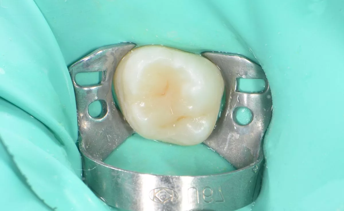 Детская стоматология в Москве. Лечение кариеса зуба у подростков