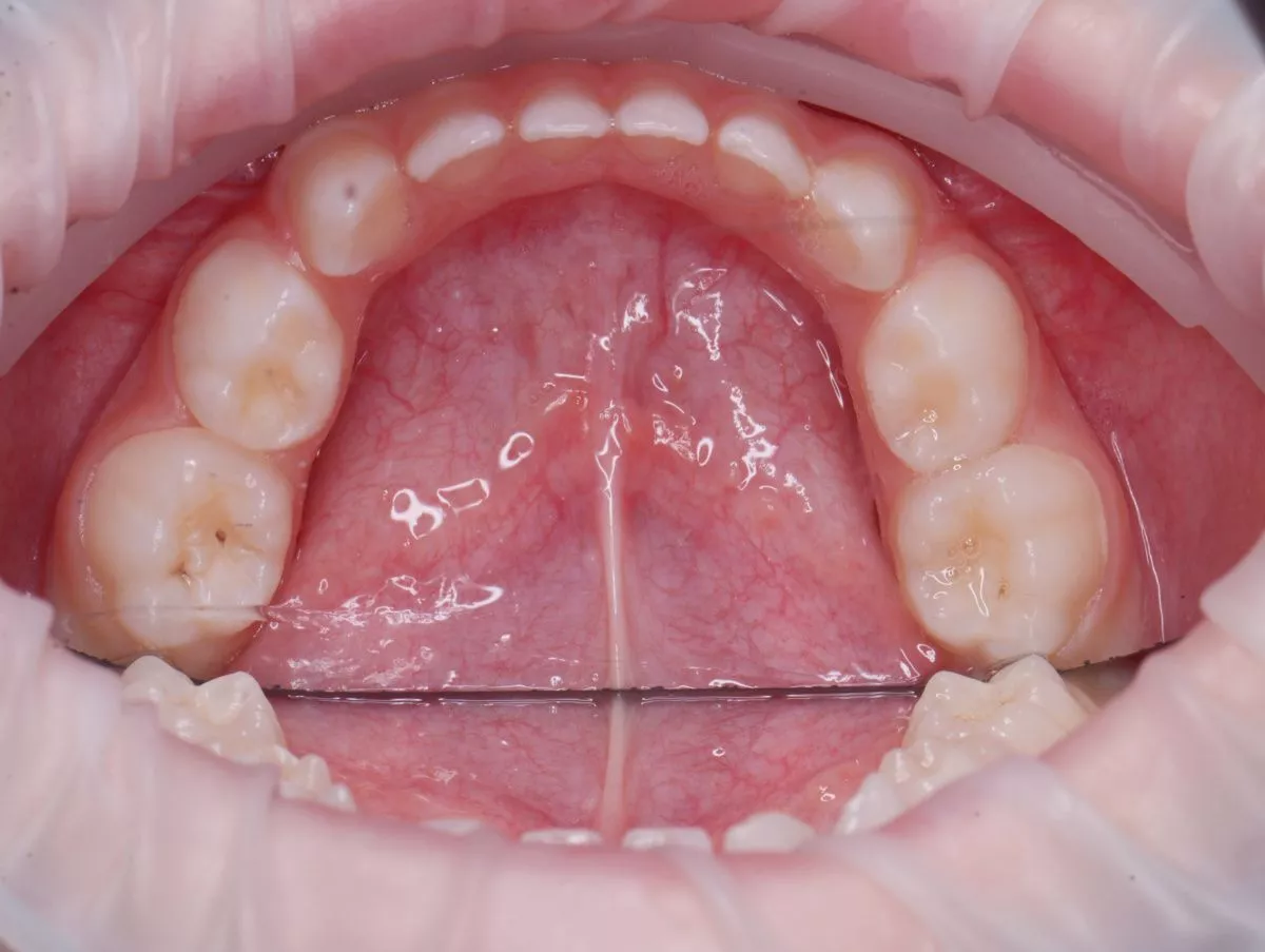 Детская стоматология Мичуринский. Лечение кариеса зубов у детей - до процедуры