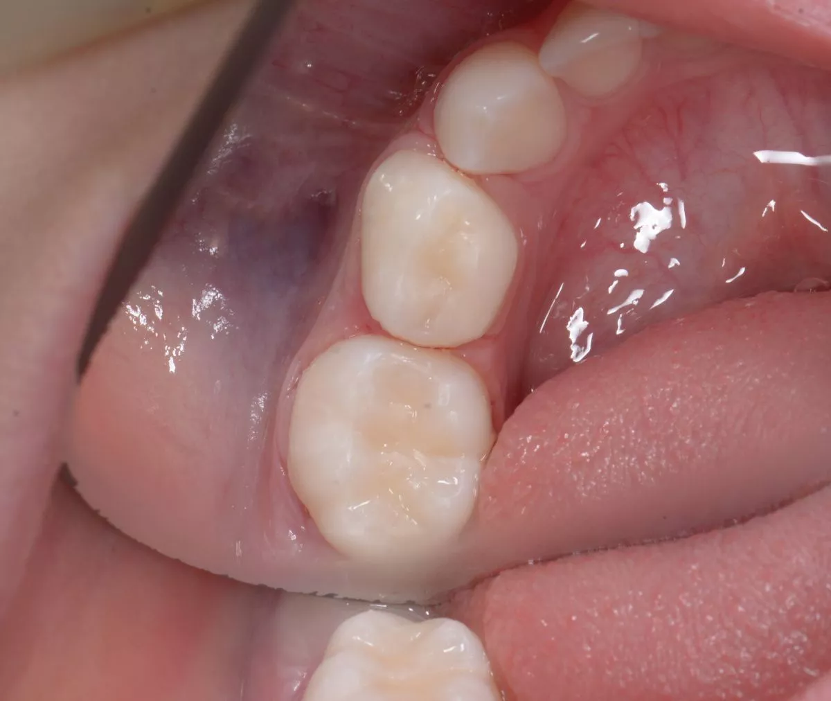 етская стоматология под наркозом Москва. Лечение контактного кариеса у детей