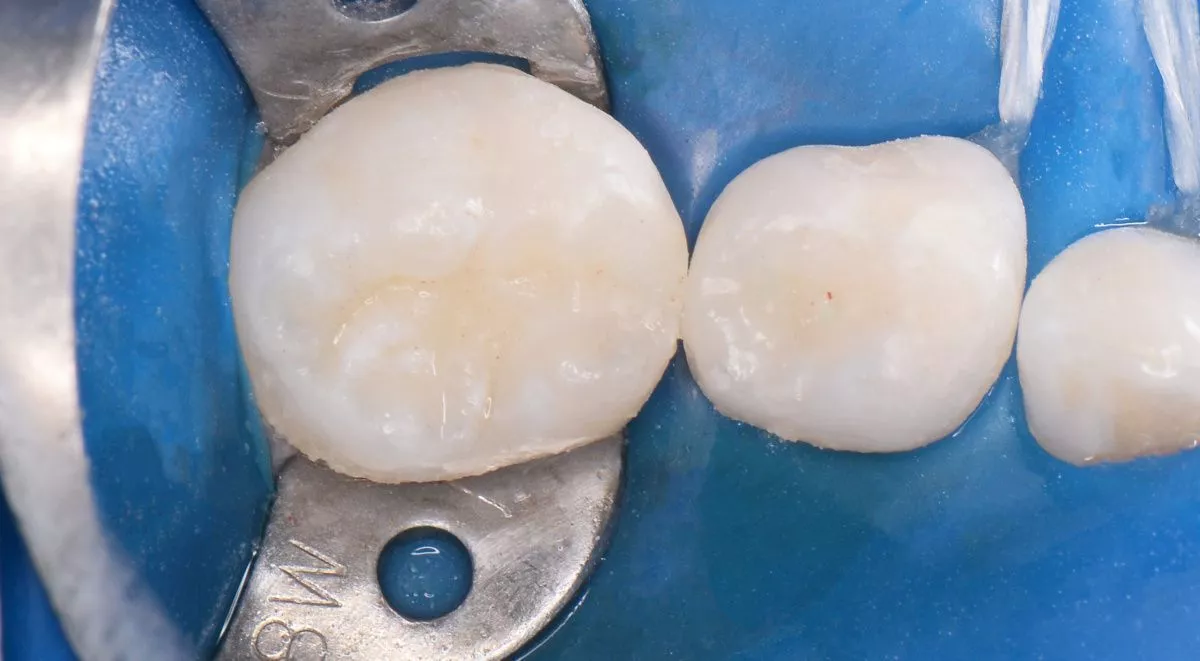 Детская стоматология Мичуринский. Лечение кариеса в межзубном промежутке у детей