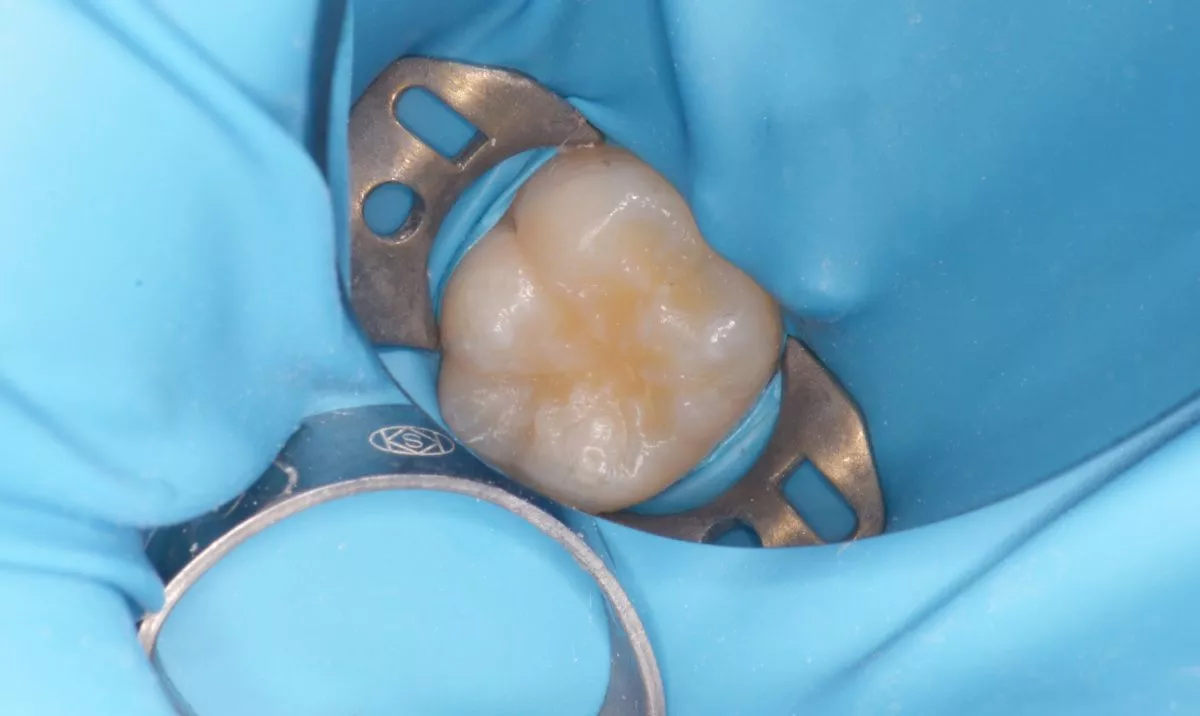 етская стоматология под наркозом Москва. Герметизация фиссур постоянного зуба - до процедуры