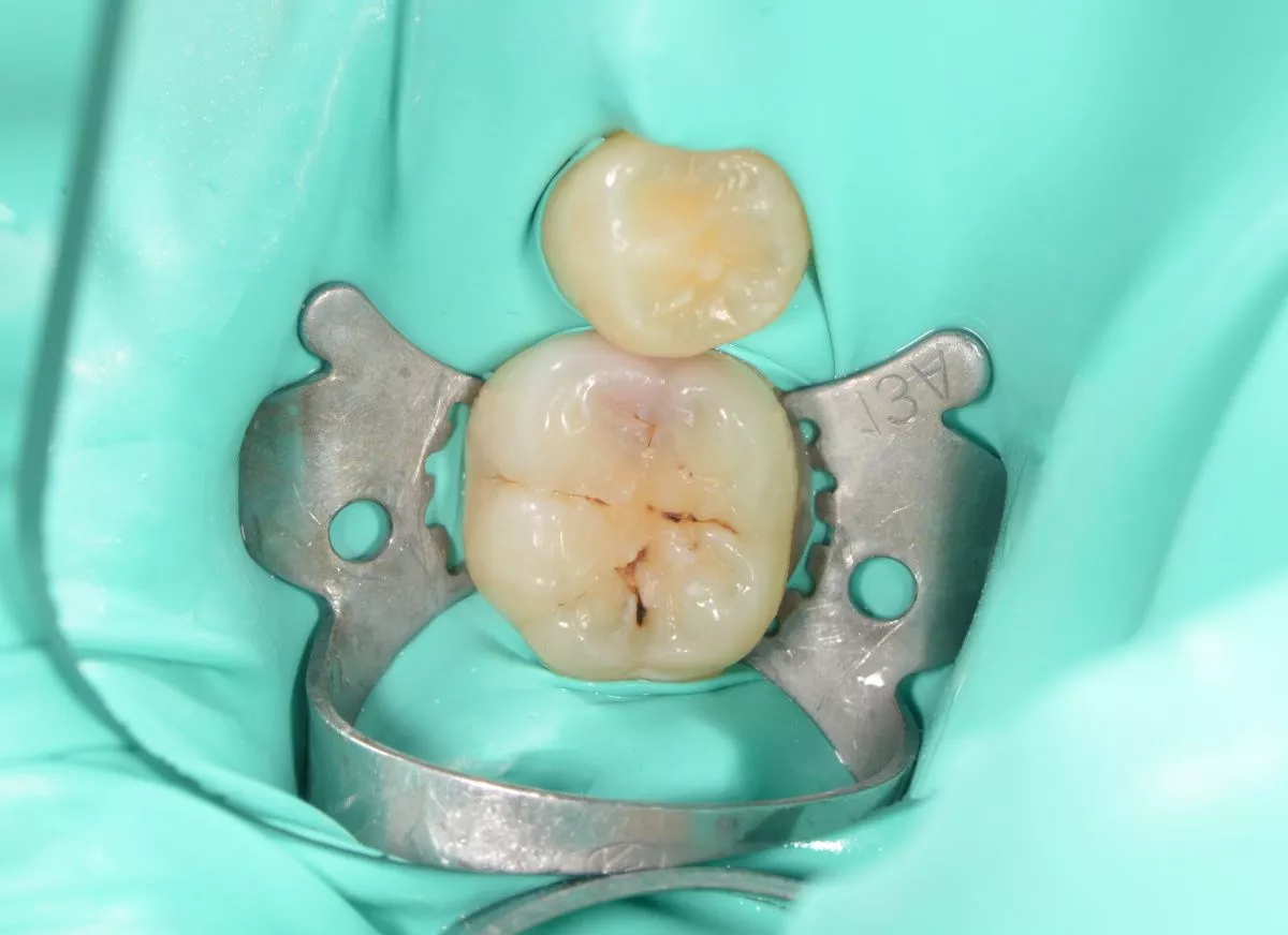 Детская стоматология в Москве. Лечение кариеса жевательного зуба детям - до процедуры