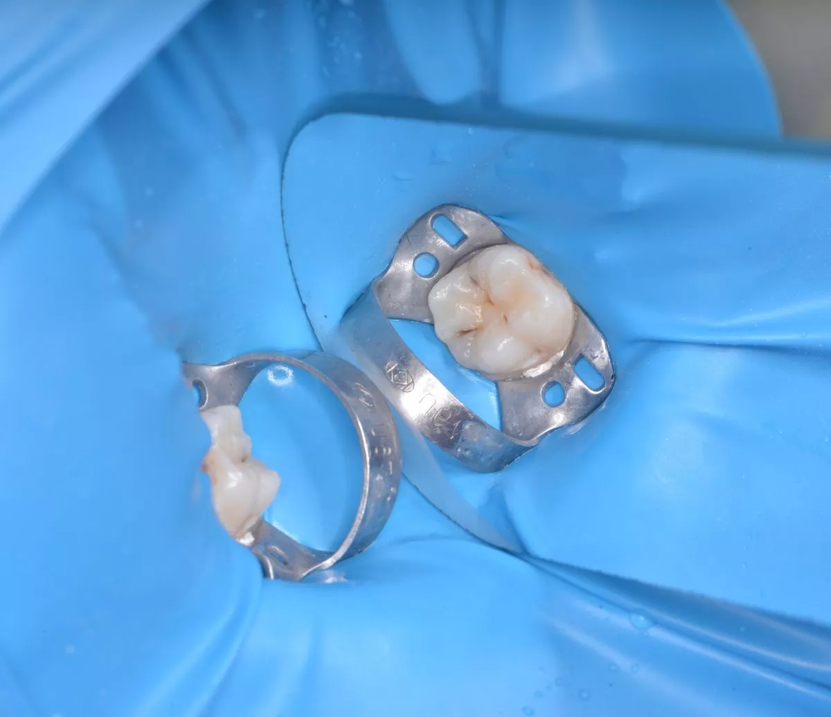 Детская стоматология с наркозом. Лечение кариеса у детей с восстановлением фиссур - до процедуры