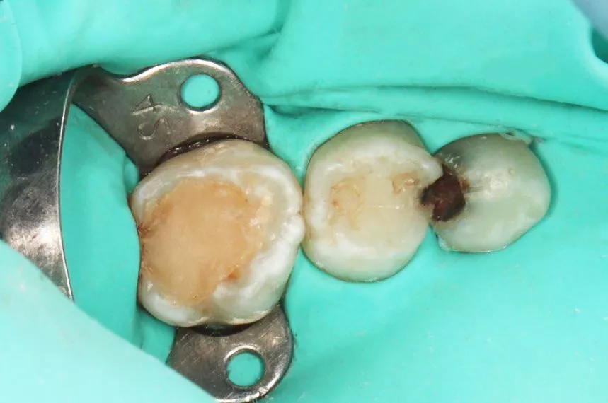 Лучшие детские врачи стоматологи. Лечение кариесов зубов у подростков - до процедуры