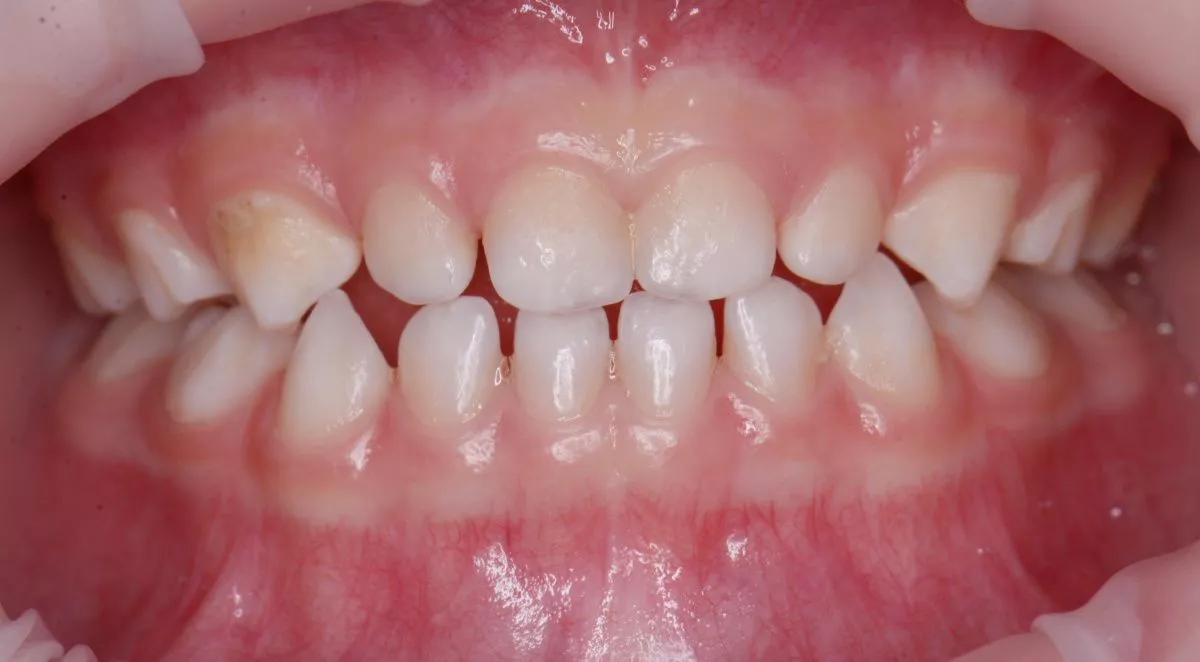 Детская стоматология Мичуринский. Гигиена в сменном прикусе у детей - до процедуры