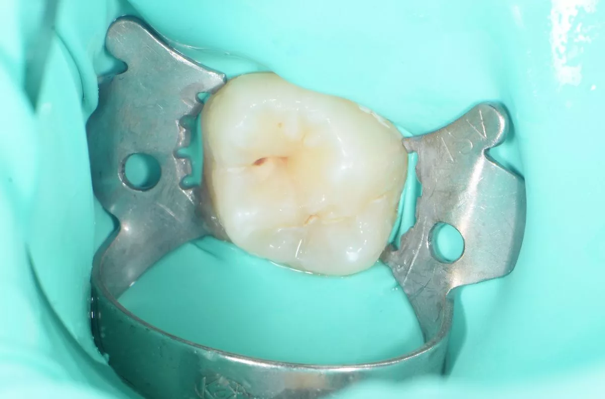 Детская стоматология в Москве. Лечение кариеса жевательного зуба у подростка - до процедуры