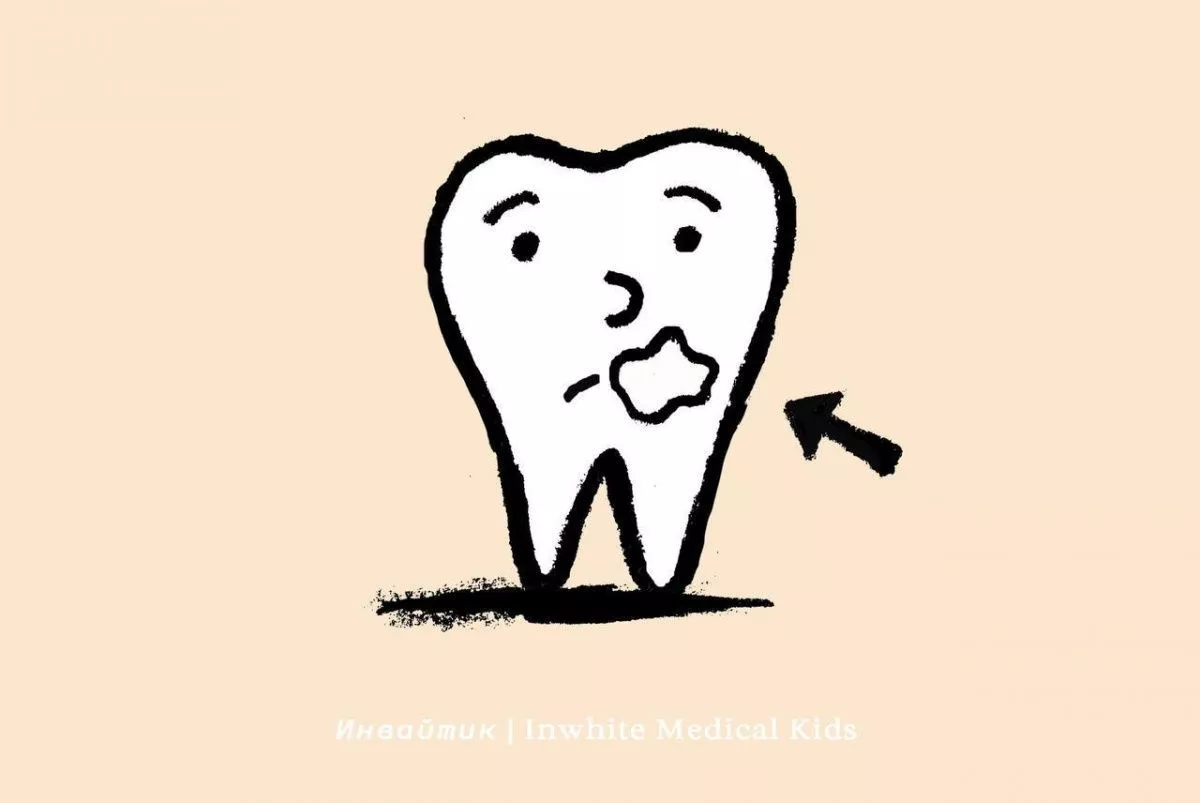 Как проходит лечение кариеса в стадии пятна у детей?
