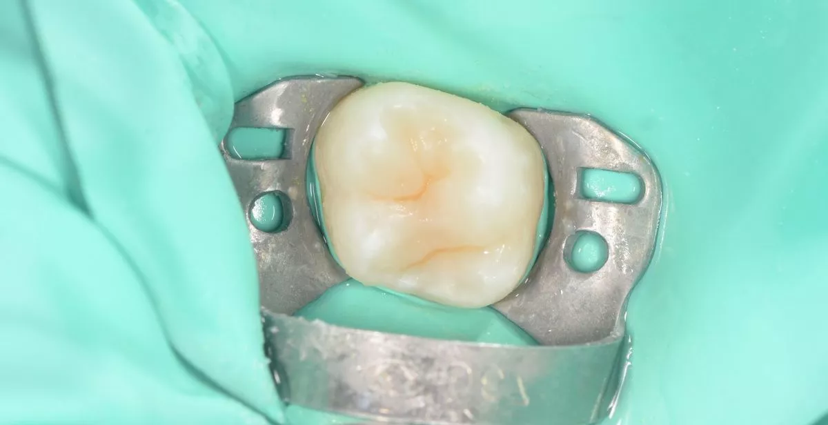 Детская стоматология в Москве. Лечение кариеса жевательного зуба у ребенка