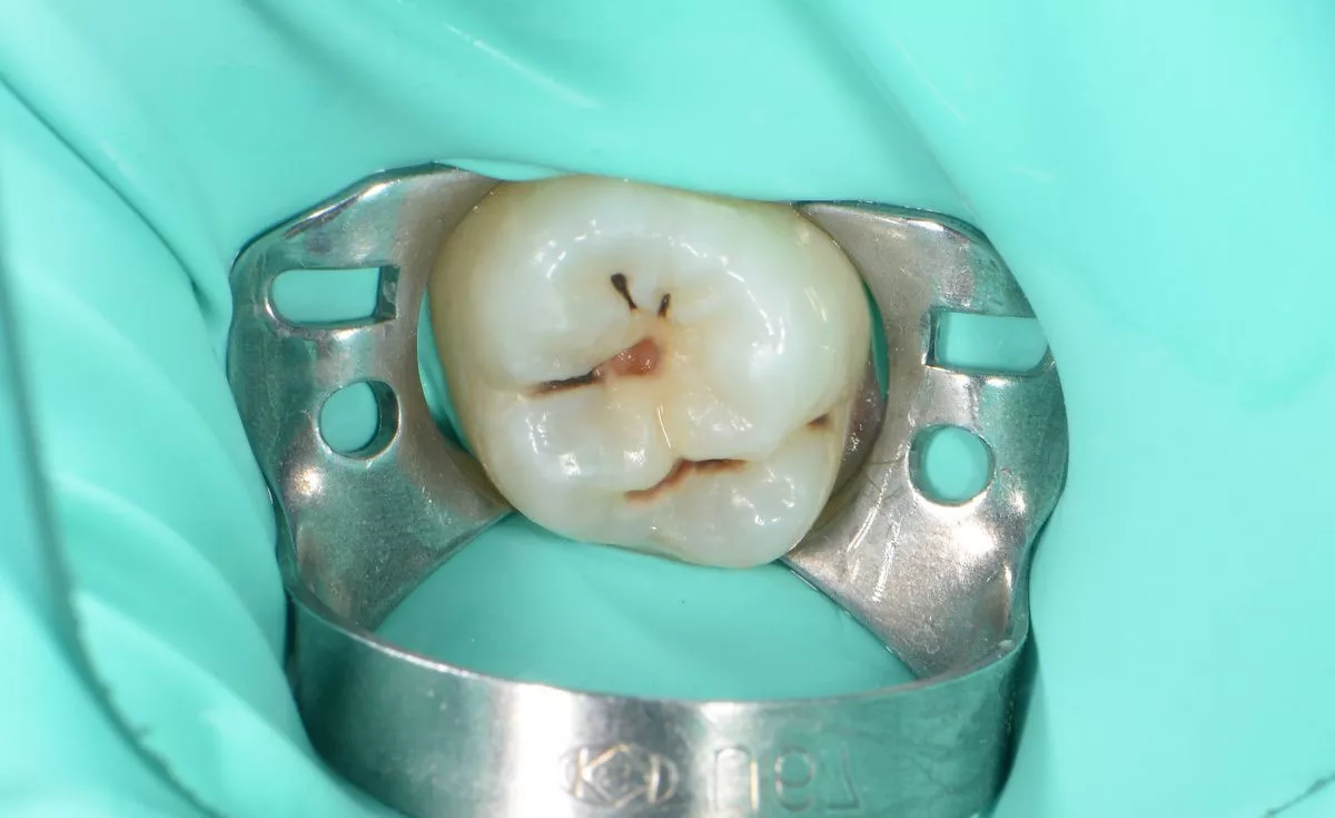 Детская стоматология в Москве. Лечение кариеса зуба у подростков - до процедуры