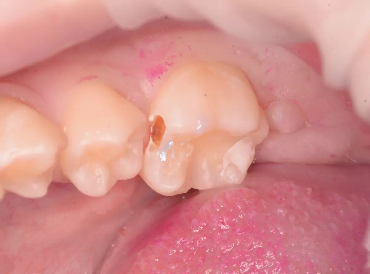 Детская стоматология Мичуринский. Лечение среднего кариеса у детей - до процедуры