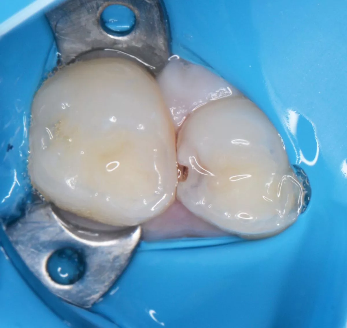 етская стоматология лечение под наркозом. Лечение контактного кариеса детям - до процедуры