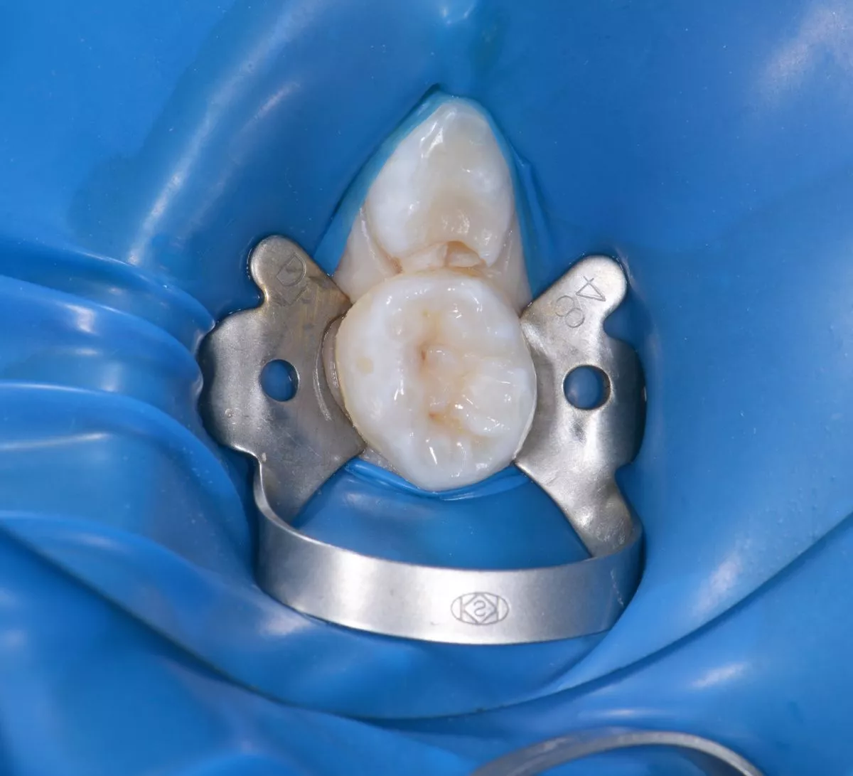 етская стоматология под наркозом Москва. Лечение кариеса и герметизация фиссур - до процедуры