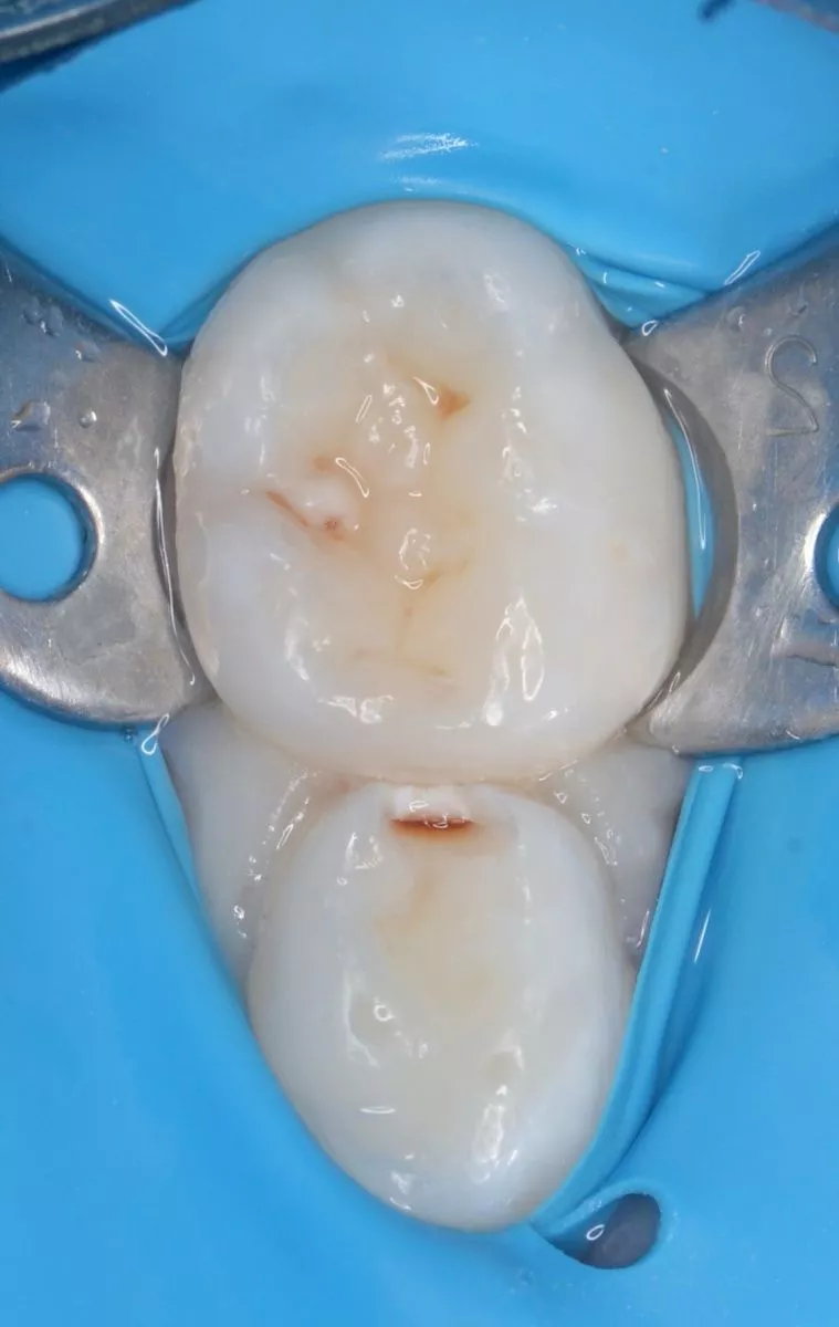 етская стоматология лечение под наркозом. Лечение кариеса с герметизацией фиссур детям - до процедуры