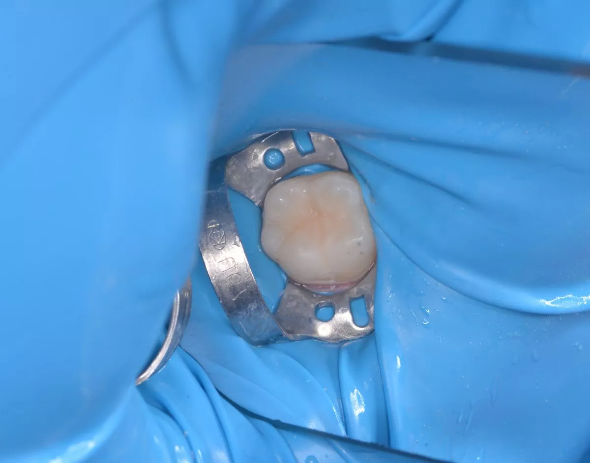 Детская стоматология с наркозом. Лечение кариеса постоянного зуба у детей