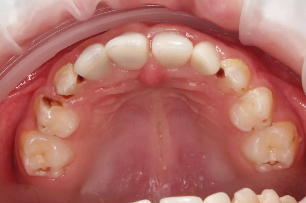 Лучшие детские врачи стоматологи. Лечение зубов с установкой керамических и железных коронок у детей - до процедуры