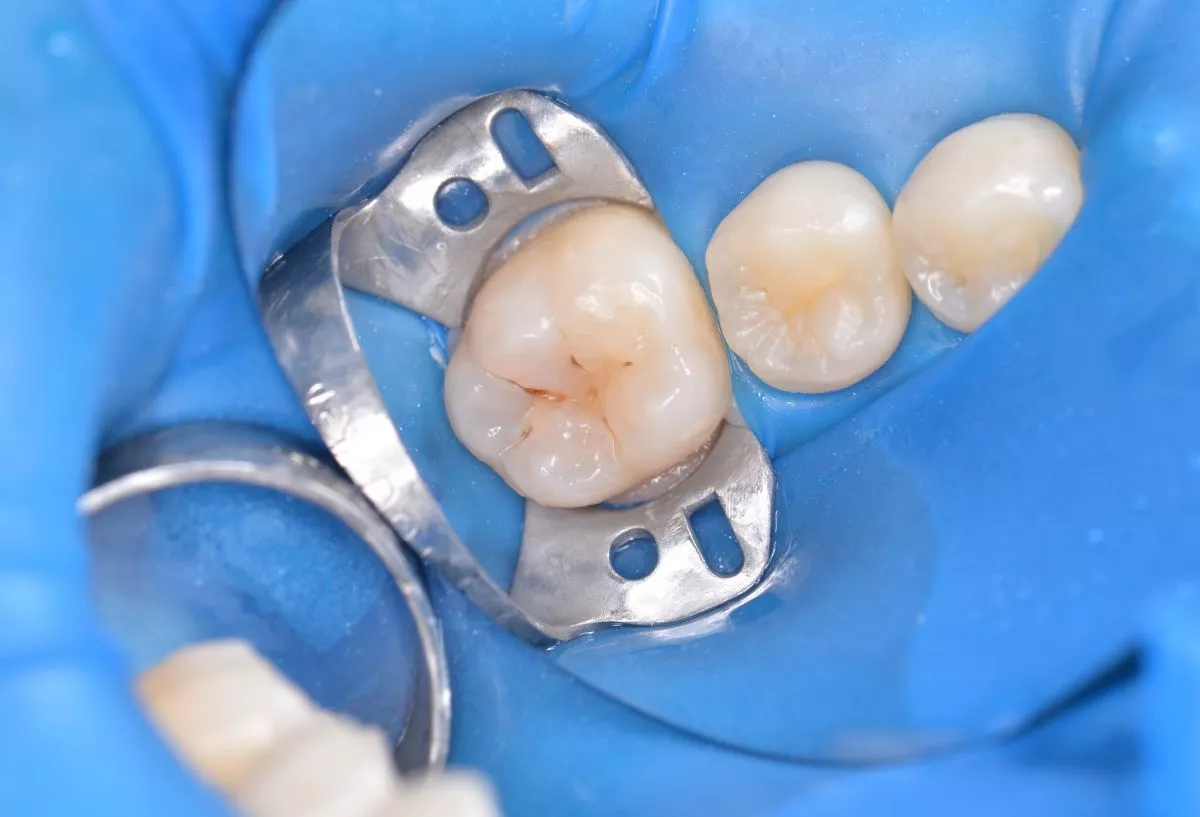 Детская стоматология с наркозом. Лечение скрытого кариеса постоянного зуба - до процедуры