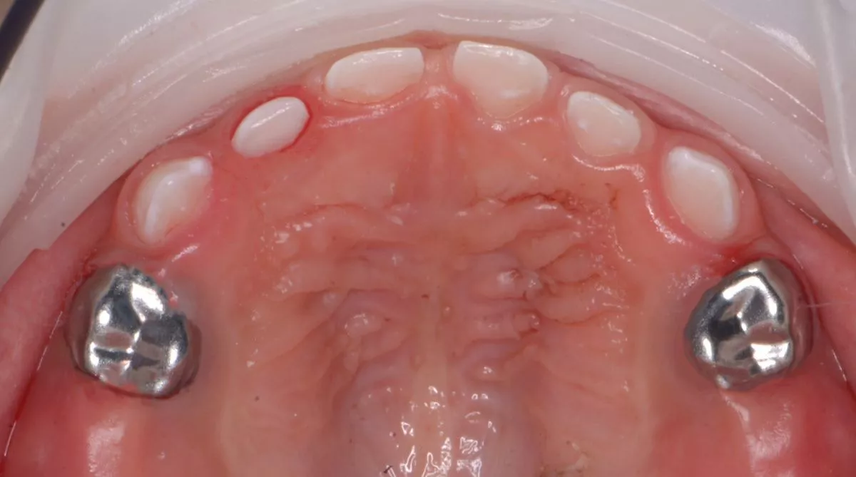 етская стоматология лечение под наркозом. Лечение детей в наркозе - установка металлических коронок