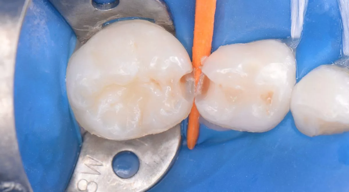 Детская стоматология Мичуринский. Лечение кариеса в межзубном промежутке у детей - до процедуры