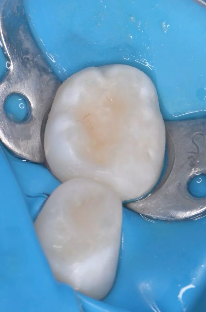 етская стоматология лечение под наркозом. Лечение кариеса с герметизацией фиссур детям