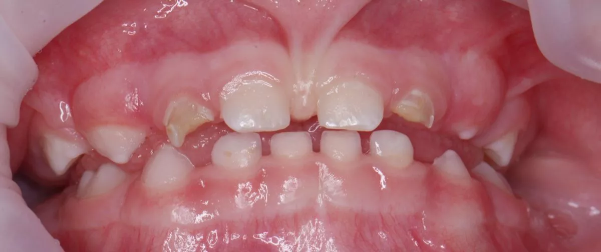 етская стоматология лечение под наркозом. Лечение под наркозом - установка коронок и профессиональная гигиена у детей - до процедуры