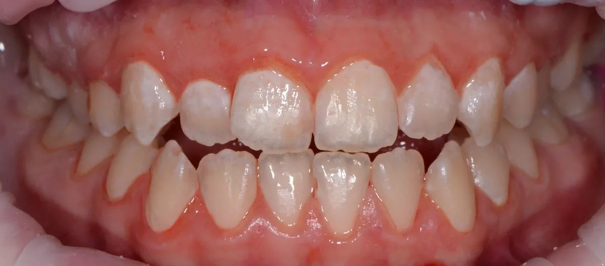 Детская стоматология Мичуринский. Профессиональная гигиена зубов у детей 