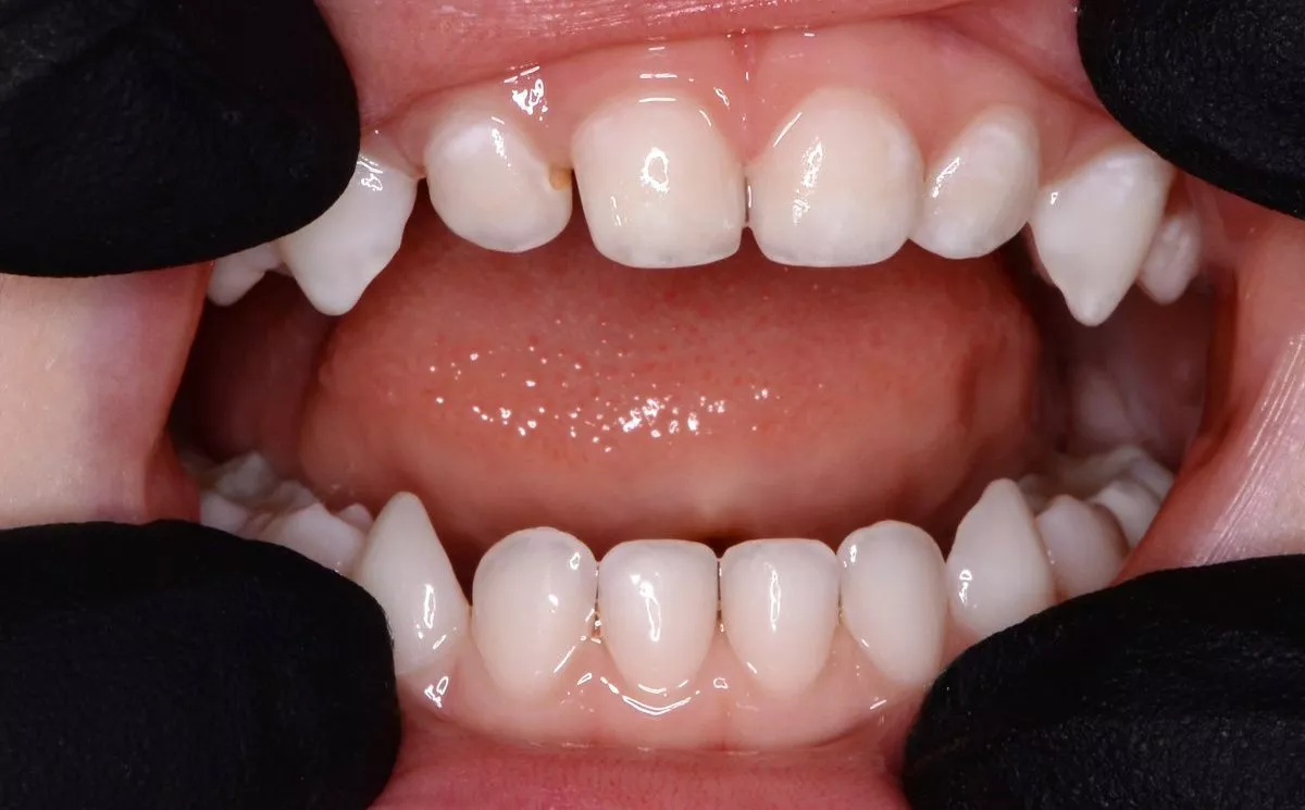 етская стоматология лечение под наркозом. Профессиональная гигиена для детей