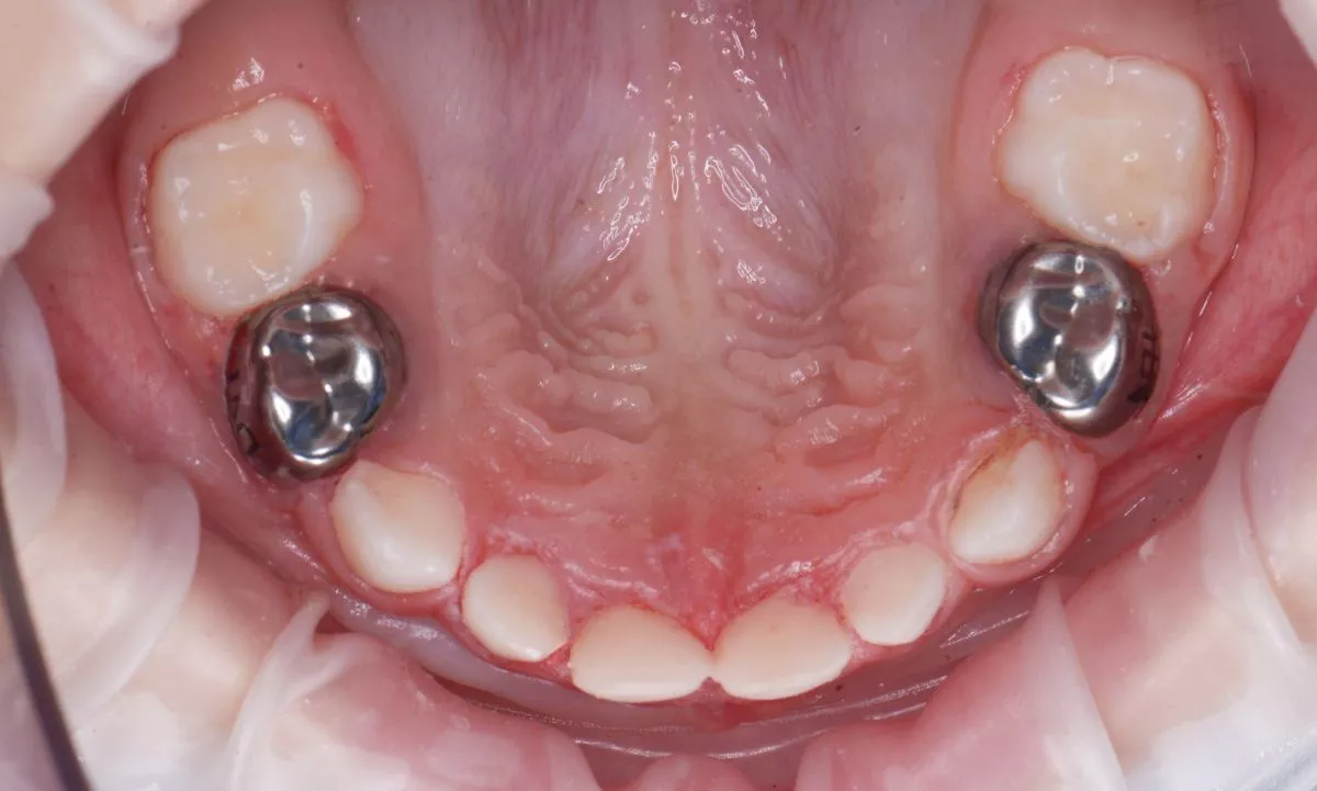 етская стоматология под наркозом Москва. Установка металлических коронок детям