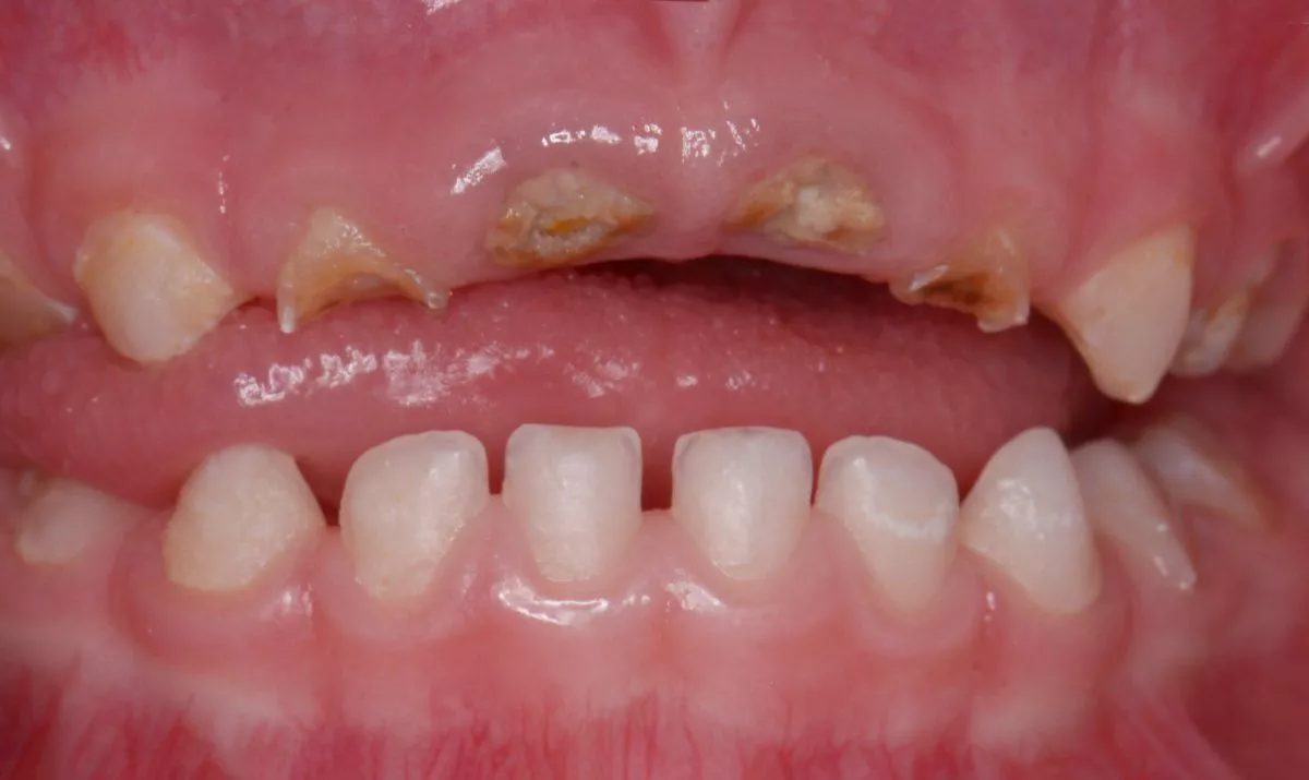 Детская стоматология с наркозом. Лечение во сне - установка керамических и металлических коронок - до процедуры