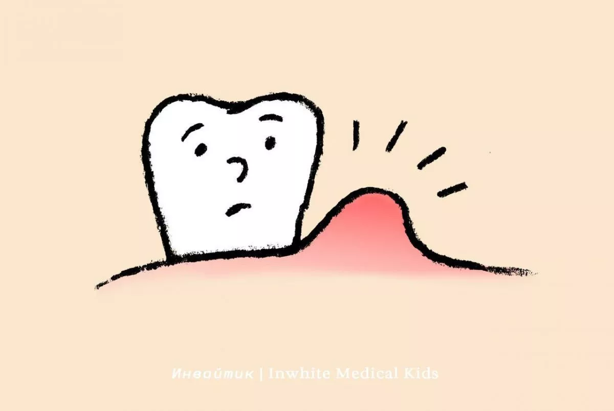 Можно ли спасти молочный зуб со свищом?