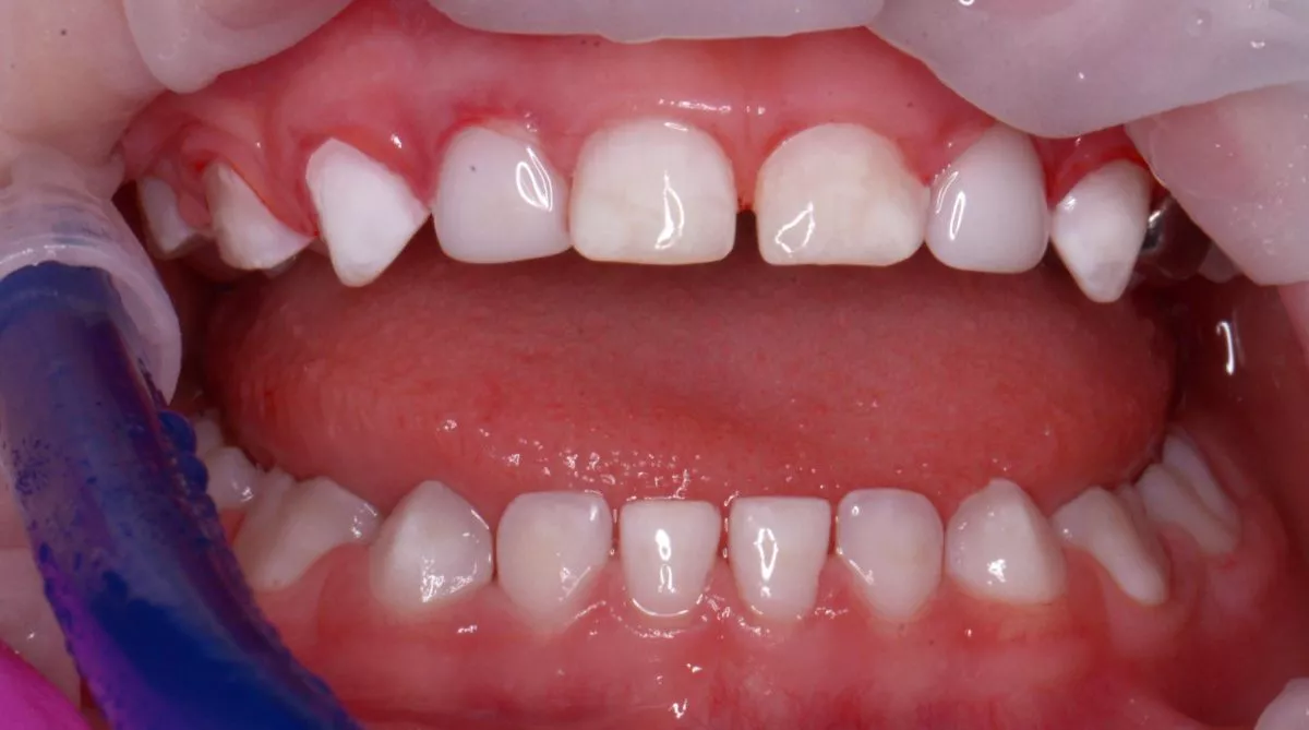 етская стоматология лечение под наркозом. Лечение зубов в седации для детей