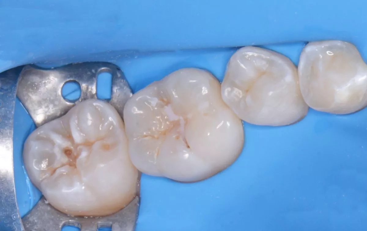 Детская стоматология наркоз Москва. Лечение кариеса жевательных зубов у детей - до процедуры