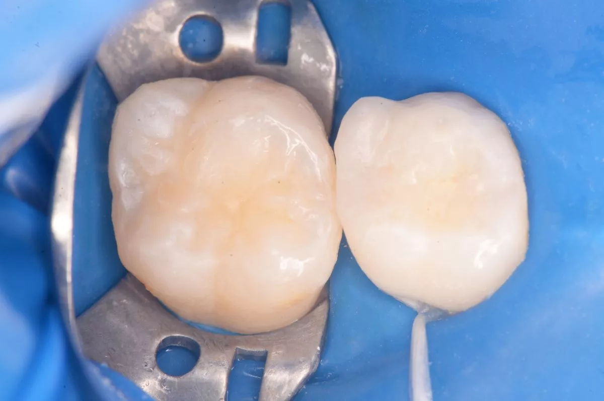 Детская стоматология Мичуринский. Контактный кариес с восстановлением контактного пункта