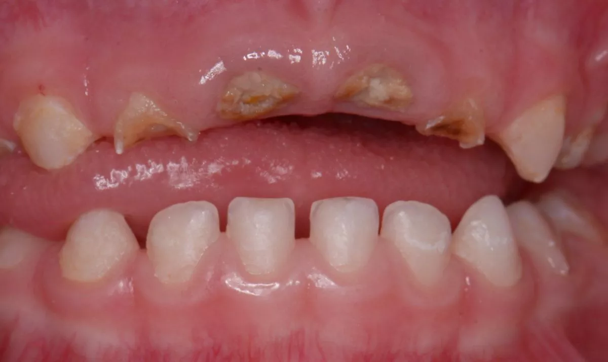 Детская стоматология наркоз Москва. Лечение зубов в наркозе у детей - до процедуры