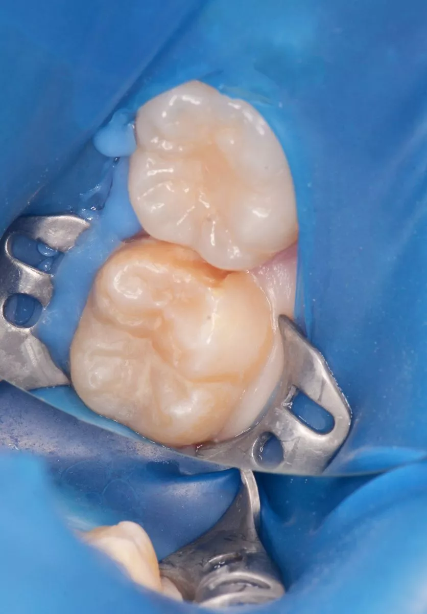 Детская стоматология Мичуринский. Лечение контактного кариеса у детей  - до процедуры