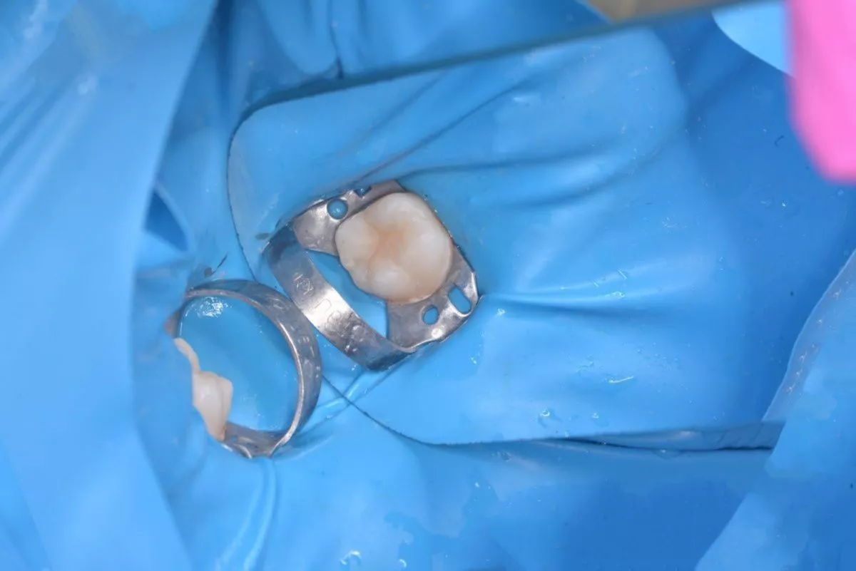 Детская стоматология с наркозом. Лечение кариеса жевательного зуба