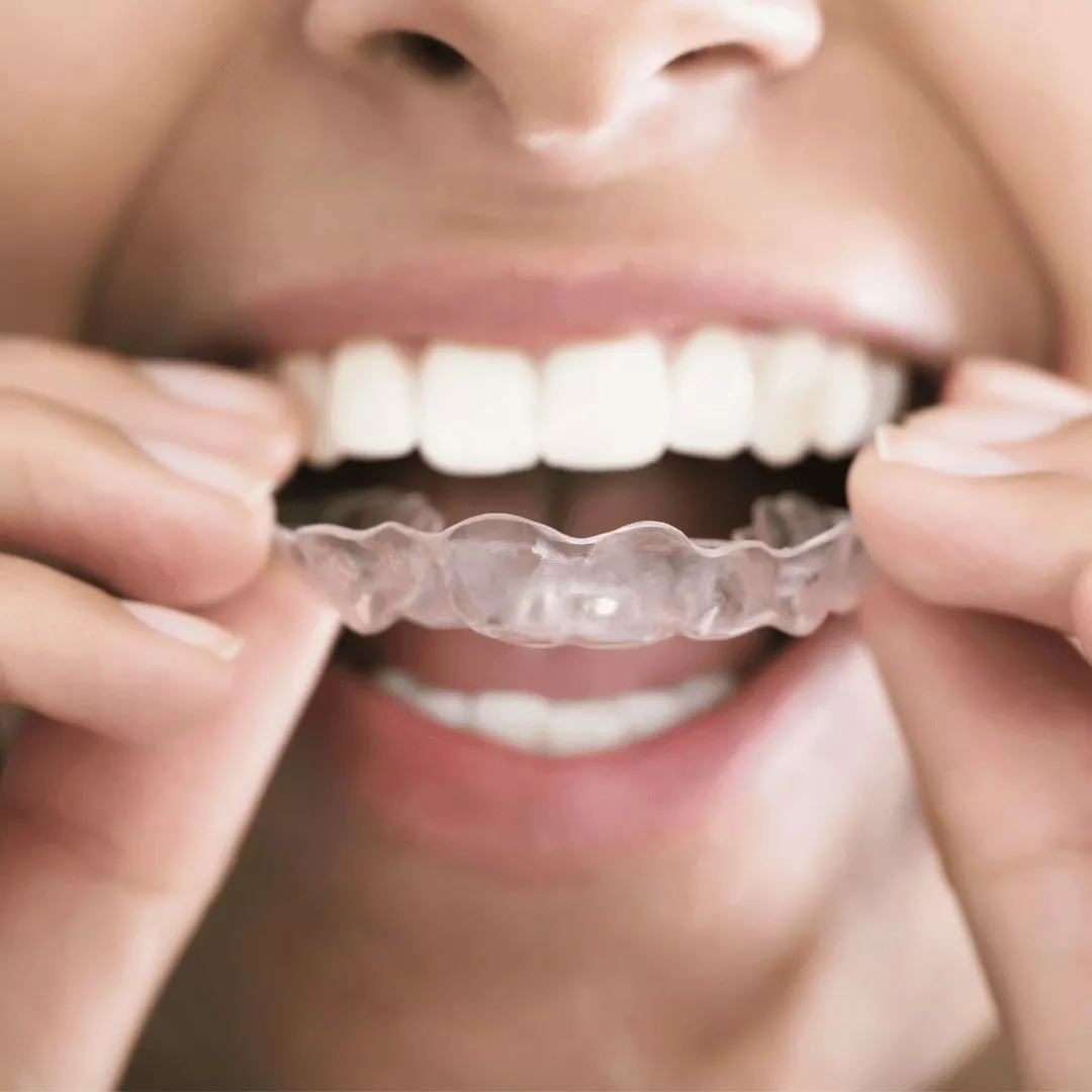 Исправление прикуса