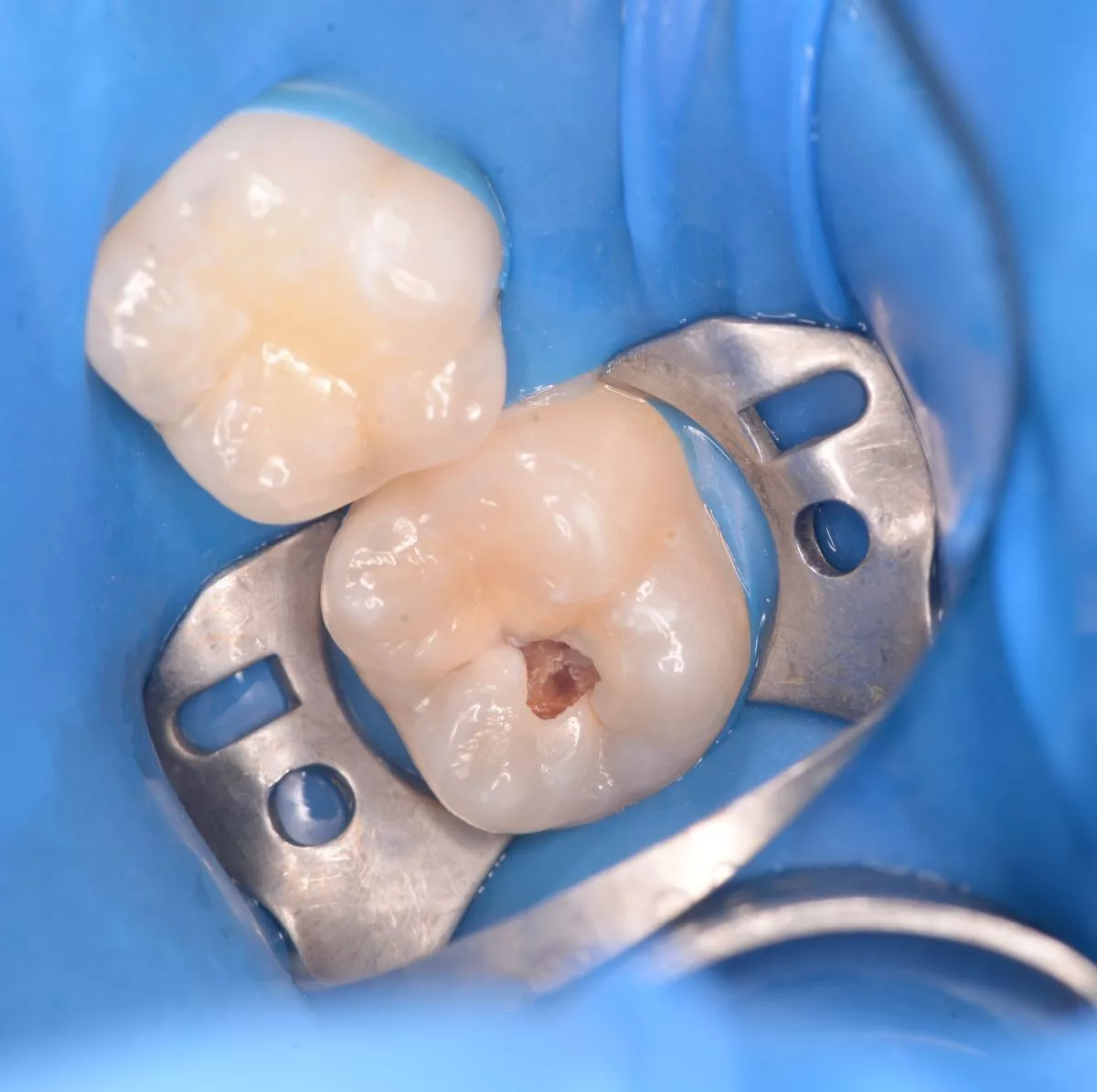 Детская стоматология Мичуринский. Средний кариес: лечение и восстановление зуба у детей - до процедуры