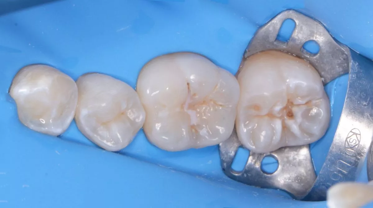 Детская стоматология с наркозом. Лечение кариеса постоянных зубов у детей - до процедуры