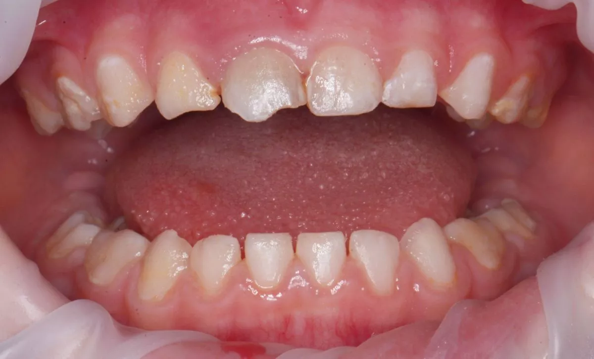 етская стоматология лечение под наркозом. Лечение во сне - установка коронок, удаление зубов и проведение профессиональной гигиены - до процедуры