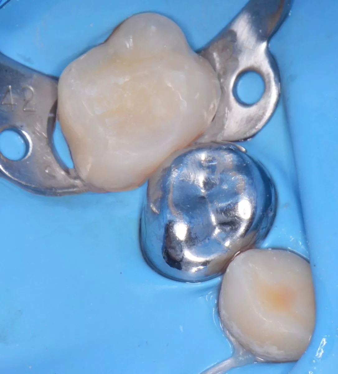 етская стоматология лечение под наркозом. Лечение контактного кариеса у детей