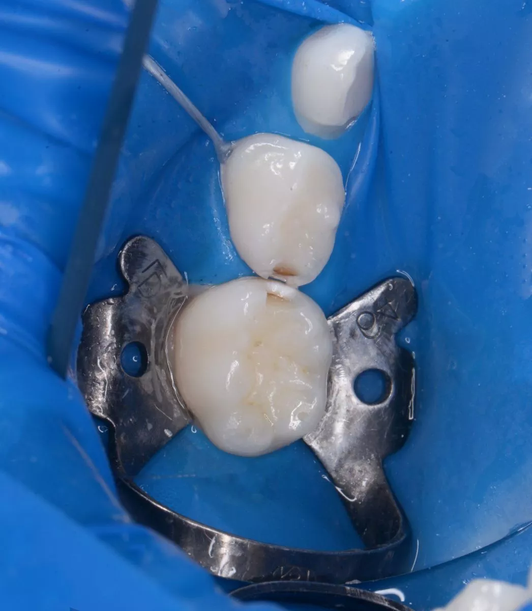 етская стоматология под наркозом Москва. Лечение контактного кариеса двух зубов - до процедуры