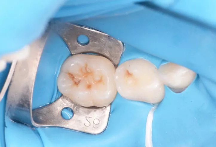 Лучшие детские врачи стоматологи. Лечение кариеса 2-х постоянных зубов у детей - до процедуры