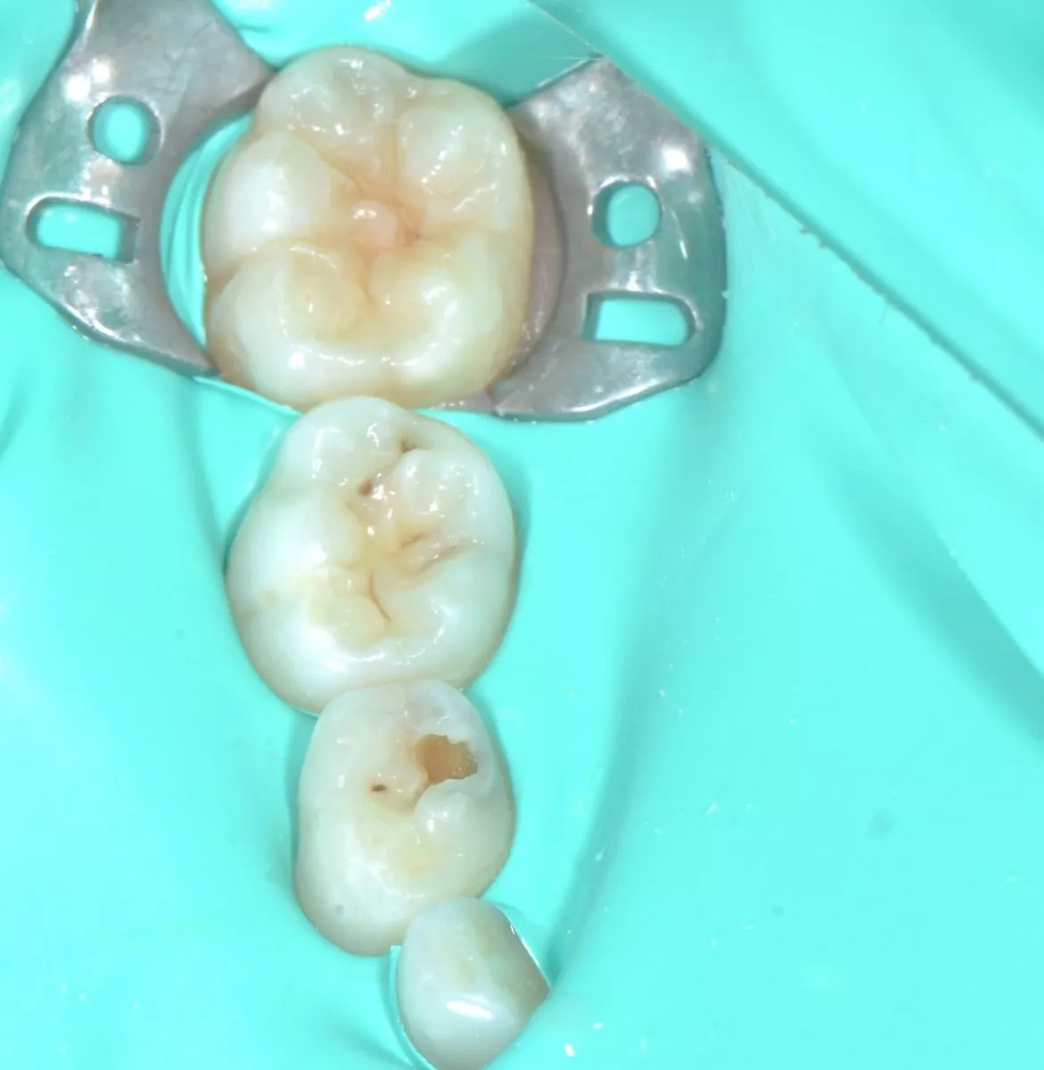 етская стоматология лечение под наркозом. Лечение кариесов и герметизация фиссур у детей - до процедуры