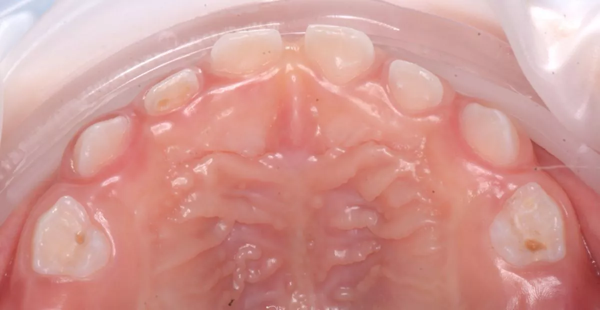 етская стоматология лечение под наркозом. Лечение детей в наркозе - установка металлических коронок - до процедуры