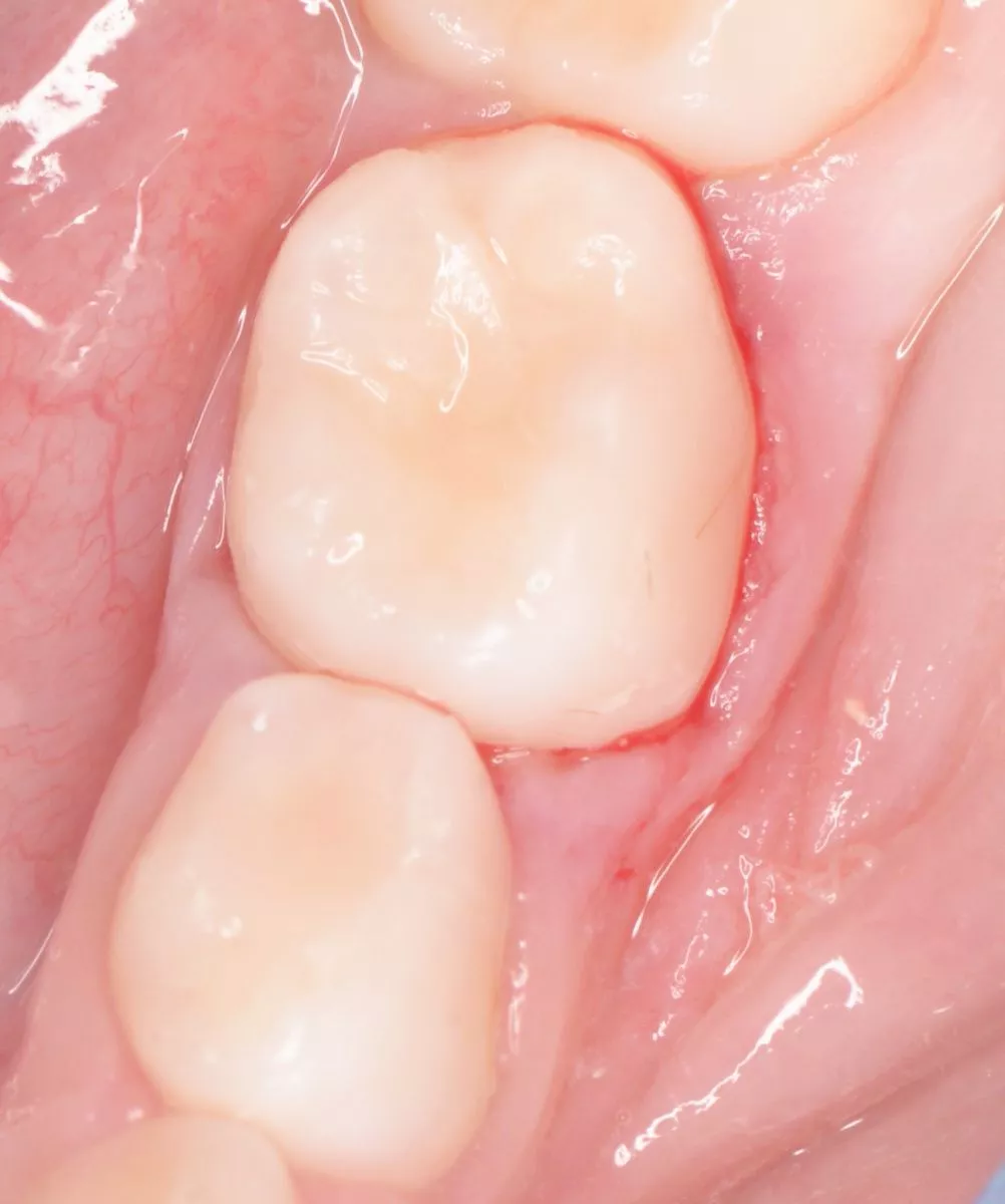 етская стоматология лечение под наркозом. Лечение множественного кариеса у детей