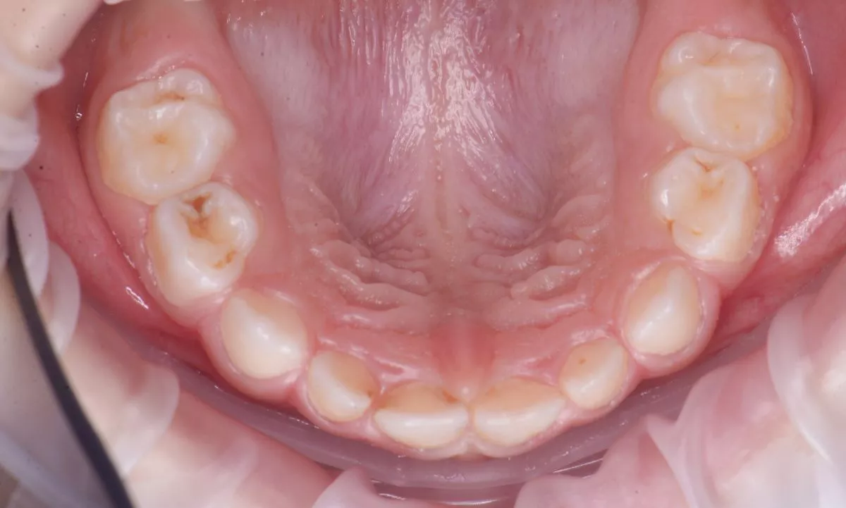 етская стоматология под наркозом Москва. Установка металлических коронок детям - до процедуры